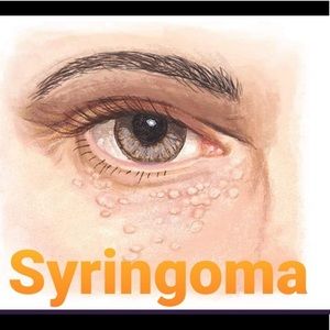 Syringoma Cream Remove Syringoma 100% Effective